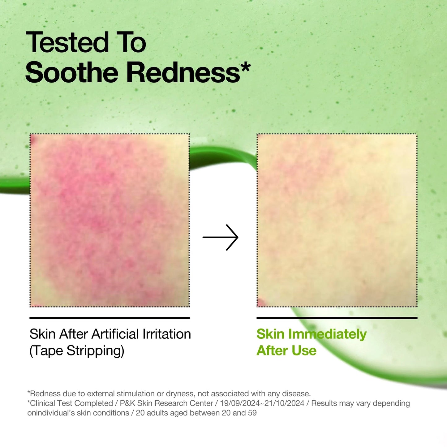 Anua Azelaic Acid 10 Hyaluron Redness Soothing Serum - 30ml